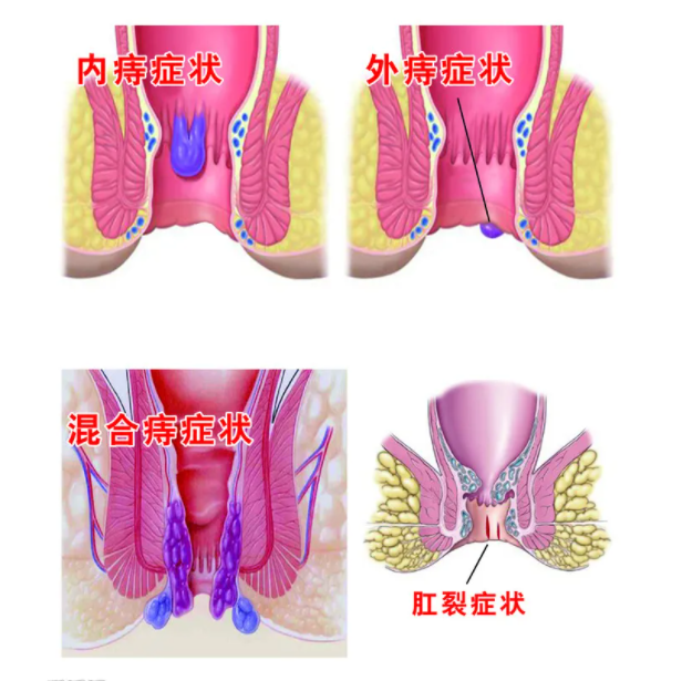 昆明中醫(yī)胃腸病醫(yī)院痔瘡檢查