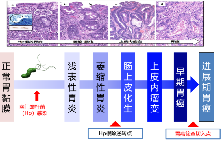 胃癌，大部分都是拖出來的？這些胃病需及時治療！