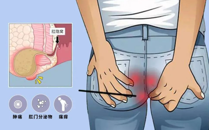 肛周膿腫拖不得！當心肛瘺緊隨其后！