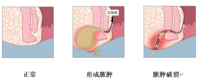 屁屁上紅腫長包？小心肛周膿腫，千萬別拖延，應盡快就醫(yī)！